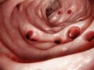 Diverticulite