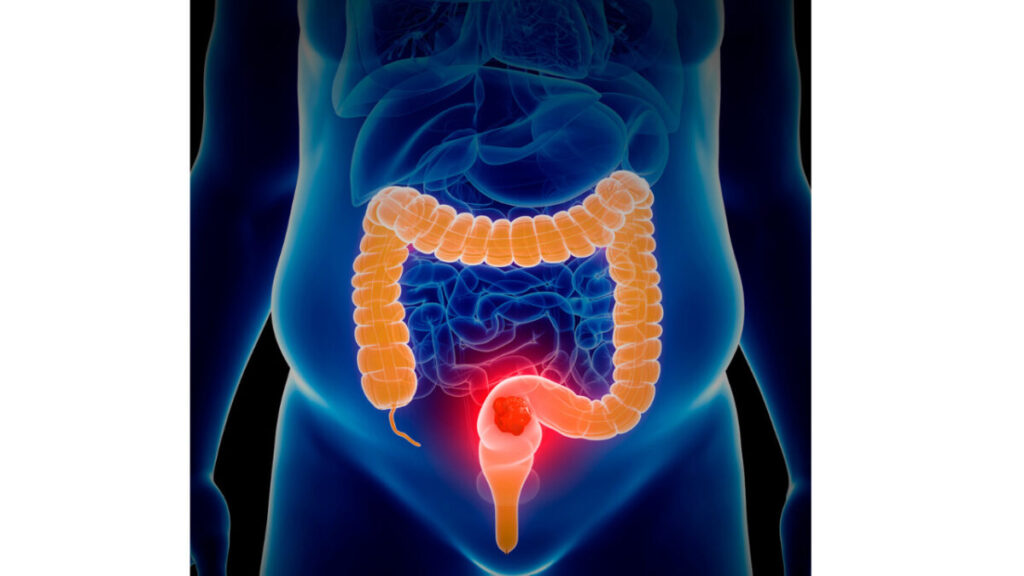 Inércia Colônica Inércia Colônica