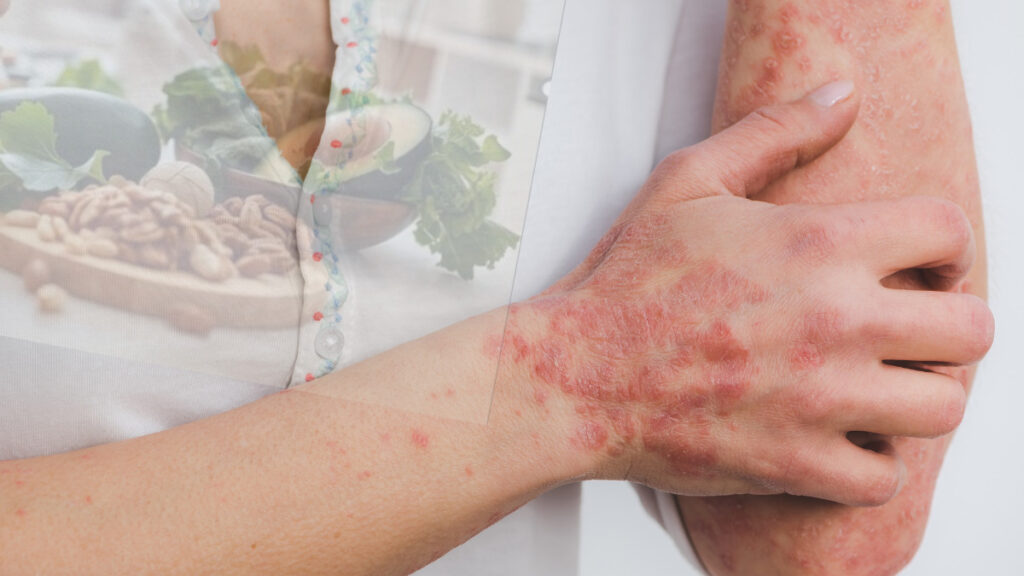 Impacto da alimentação na Psoríase